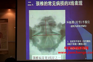 陈忠和全集陈忠和整脊术复位视频教程合集百度云网盘下载学习