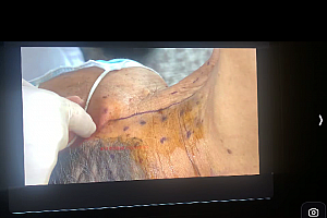 段作峰液波透骨疗法视频课程百度网盘下载学习